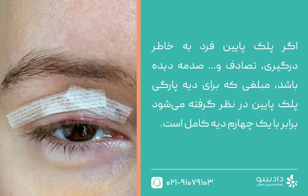 دیه پارگی پلک بالا